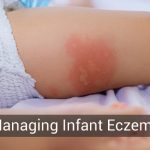 Baby eczema causes and treatment