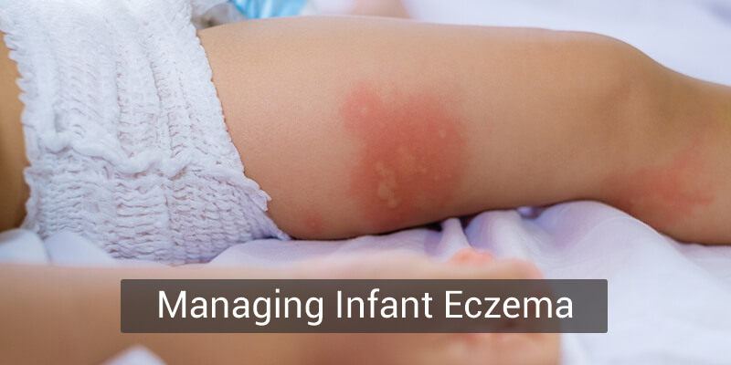 Baby eczema causes and treatment