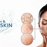Dry skin and hard water